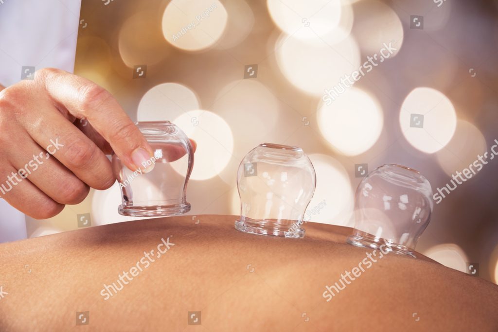 cupping